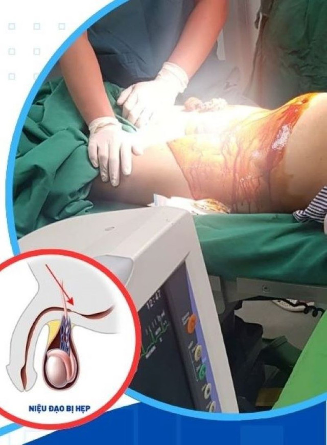 Điều trị cho bệnh nhân đái tháo đường hẹp niệu đạo - Ảnh BVCC dot-song-cao-tan-3.jpg