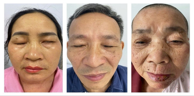 Hình ảnh một số bệnh nhân Zona biến chứng liệt mặt đã điều trị tại Khoa Da liễu – Bệnh viện TWQĐ 108 liet-mat.jpg