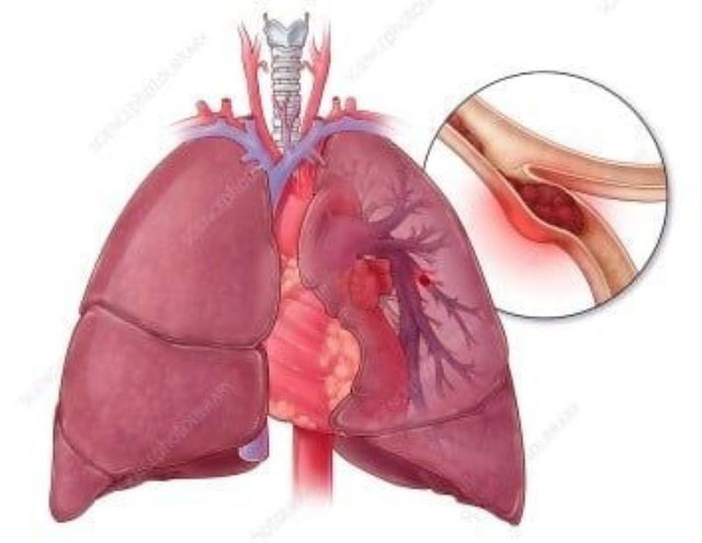 Hình 1. Hình ảnh minh hoạ thuyên tắc phổi (Nguồn: sciencephoto.com) tranhthai1.jpg