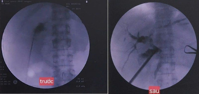 Hình ảnh trước và sau can thiệp - Ảnh BVCC soi.jpg