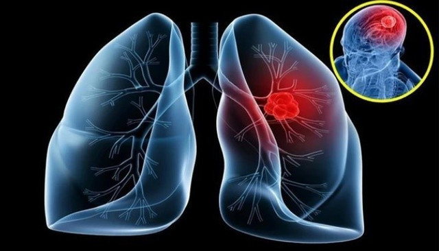 Trong số những bệnh nhân ung thư phổi, 16-20 % phát triển di căn não - Ảnh BSCC ung-thu-phoi-di-can-nao-1.jpg