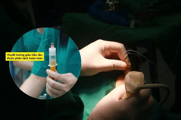 Tiêm huyết tương giàu tiểu cầu sau bẻ vận động khớp cho bệnh nhân - Ảnh BVCC dong-cung-khop-1.jpg