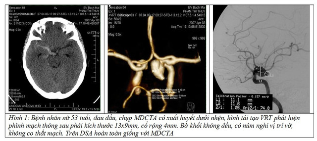 Bệnh nhân vỡ phình mạch máu não do đau đầu - Ảnh BSCC anh-2.jpg