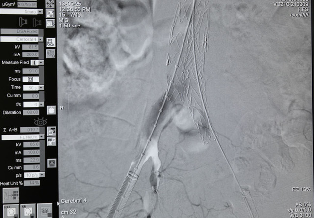 Hình ảnh Stent graft được đặt tại khối phình động mạch chủ - Ảnh BVCC can-theip-2.jpg