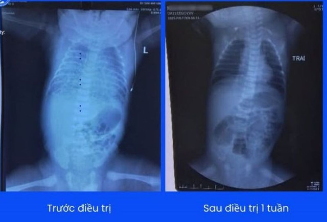 Phim chụp phổi của bé trước và sau điều trị - Ảnh BVCC 500742302-1144130824394531-8137232144385113034-n-5752.jpg