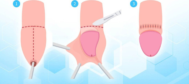 Cách xử lý cắt hẹp bao quy đầu, không đau - Ảnh BVCC cat-bao.png