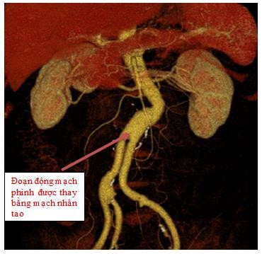 Hình ảnh phim chụp sau phẫu thuật: Đoạn động mạch phình được thay bằng mạch nhân tạo - Ảnh BVCC u-bung-2.jpg
