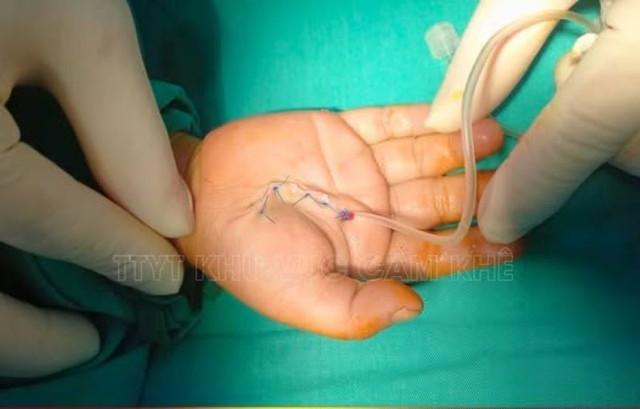 Trẻ bị mảnh thủy tinh làm đứt gân ngón tay phức tạp - Ảnh BVCC manh-vo-thuy-tinh.jpg