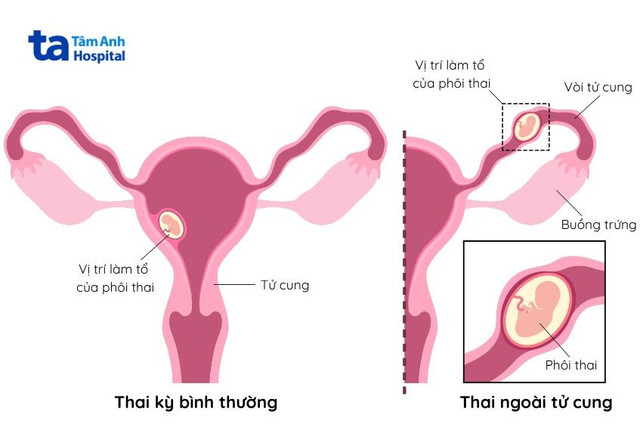 Biểu hiện của thai ngoài tử cung - Ảnh BVCC cac-truong-hop-thai-ngoai-tu-cung.jpg