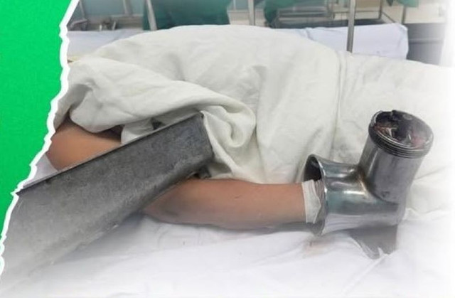 Bàn tay của nạn nhân trong máy xay thịt được mang đến viện cấp cứu - Ảnh BVCC may-xay-thit.jpg