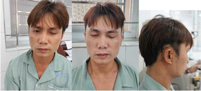 Hình ảnh mắt phải của bệnh nhân trước và sau phẫu thuật vận động nhắm mở tốt, vết mổ liền nhanh - Ảnh BVCC liet-mat-chan-thuong1.jpg
