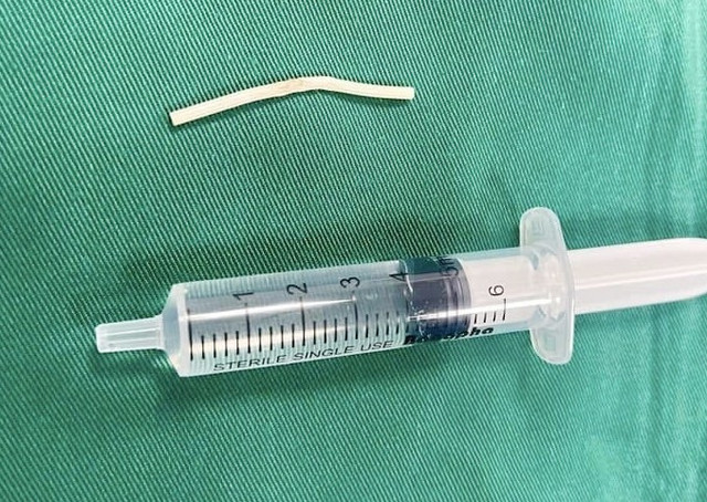 Que tránh thai được lấy ra từ cánh tay bệnh nhân - Ảnh BVCC que-thai.jpg