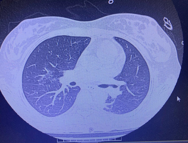 ECMO cứu nữ sinh 19 tuổi phổi trắng xóa trên nền tiểu đường ảnh 1 phoi-trang-xoa-3.jpg