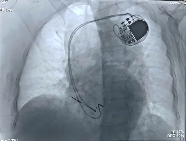 Hình ảnh máy tạo nhịp vĩnh viễn qua phim chụp DSA - Ảnh BVCC may-tao-nhip-2.jpg