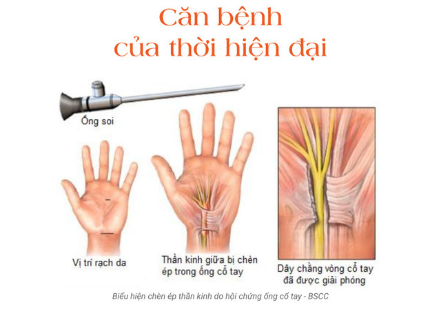 Biểu hiện chèn ép thần kinh do hội chứng ống cổ tay - BSCC hoi-chung-ong-co-tay-2.jpg