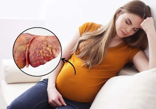 Gan nhiễm mỡ cấp tính thai kỳ là bệnh lý cực kỳ nguy hiểm - Ảnh minh họa BVCC gna-nhiem-mo-thai-ky.jpg