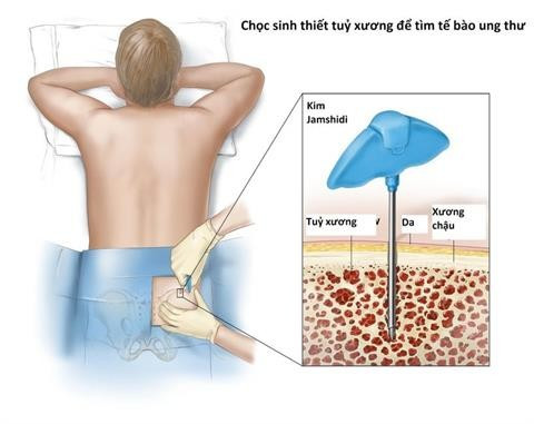 Chọc sinh thiết xương để chẩn đoán - Ảnh minh họa nguồn Internet sinh-thiet-tuy-xuong-la-gi-vai-tro-cua-sinh-thiet-tuy-xuong-trong-chan-doan-va-dieu-tri.jpg