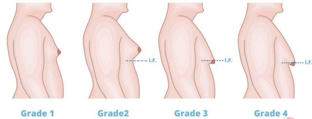 Phân loại phì đại tuyến vú ở nam - Ảnh BVCC phi-dai-1.jpg