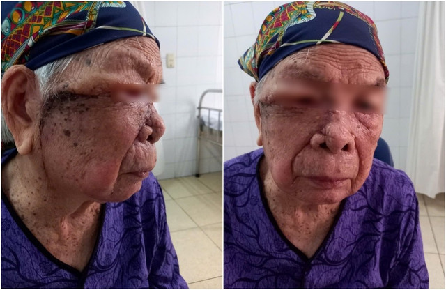 Vết mổ liền rất tốt, không rõ sẹo trên gương mặt người bệnh sau khi mổ bóc u lớn - Ảnh BVCC u-lon-mat-2.jpg