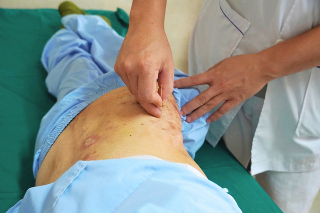 Châm cứu trị đau thần kinh do zona - Ảnh BVCC zona1.jpg