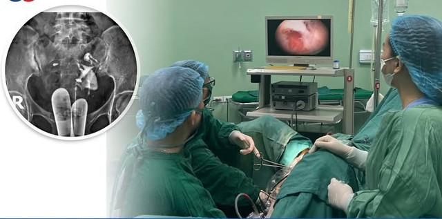 Các bác sĩ thực hiện phẫu thuật tách dính buồng tử cung cho bệnh nhân - Ảnh BVCC tach-dinh-buong-tu-cung.jpg
