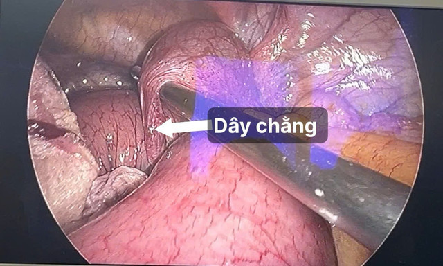 Dây chằng vắt ngang hồi tràng, đoạn ruột phía trên giãn to, tím - Ảnh BVCC tac-ruot-sau-mo-1.jpg