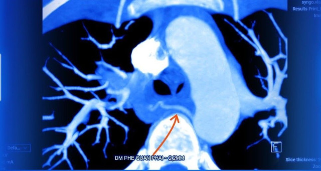 Hình ảnh CT giãn động mạch phế quản - Ảnh BVCC dau-lung-lao1.jpg