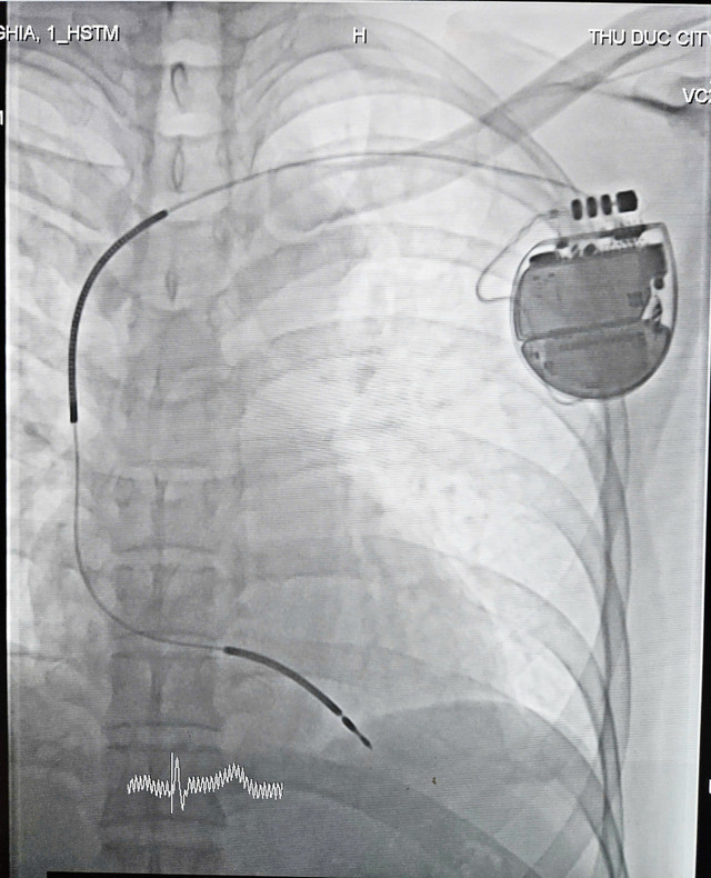 Máy phá rung ICD cấy dưới da - Ảnh BVCC cay-may-pha-rung-1.jpg