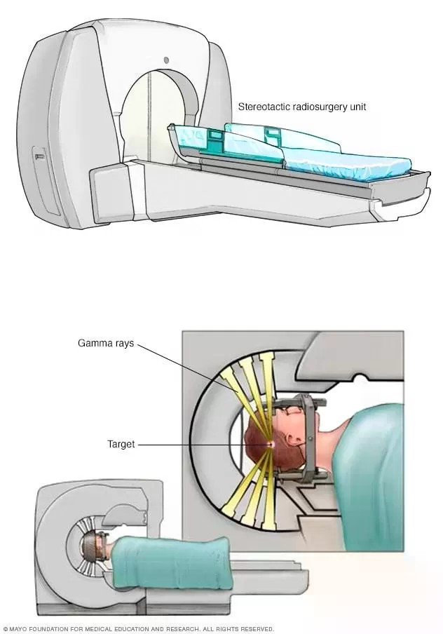 Xạ trị cho não - Ảnh BSCC ut-di-can-nao-3.jpg