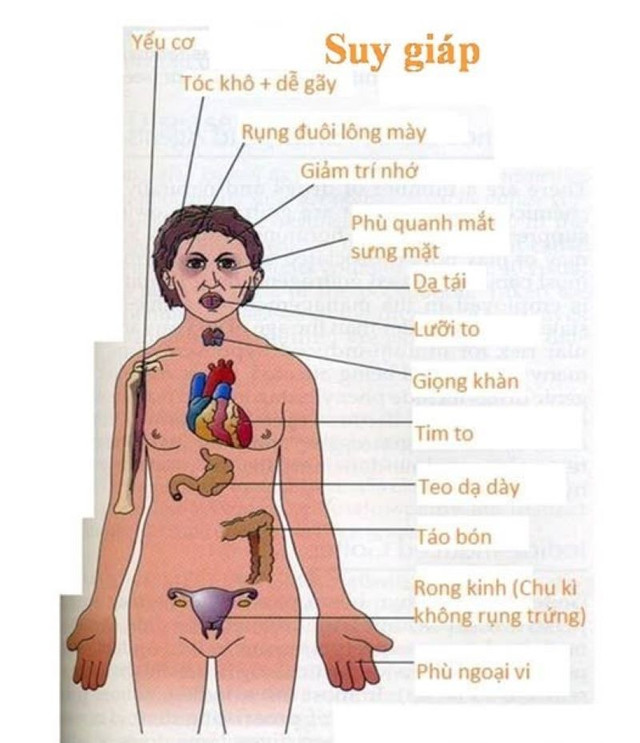 Biến chứng của suy giáp - Ảnh minh họa BV Nội tiết TƯ bien-chung-suy-giap.jpg