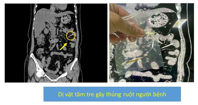 thung-ruot-2.jpg