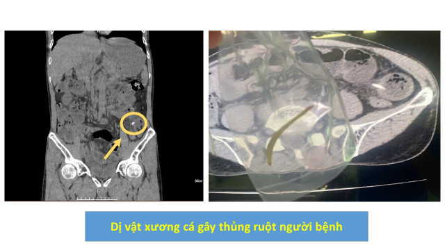 thung-ruot-1.jpg