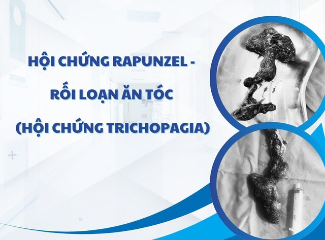 Khối tóc và bã thức ăn được lấy ra - Ảnh BVCC an-toc.jpg