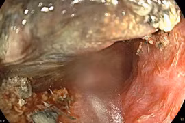 Bé 3 tuổi bị bỏng thực quản do nuốt pin cúc áo