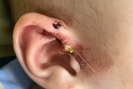 Bé trai ở Nghệ An bị lưỡi câu móc sâu vào vùng tai