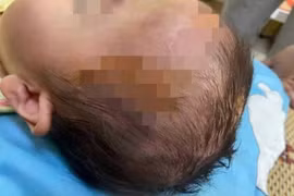 Bé gái 19 tháng tuổi bị chó cắn tổn thương nặng vùng mặt