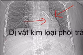 Gắp thành công cán thìa mắc sâu trong phế quản người đàn ông