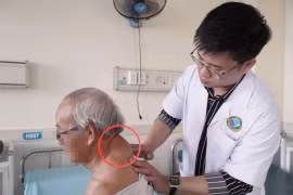 Phẫu thuật thành công khối u lớn vùng cổ cho bệnh nhân 72 tuổi