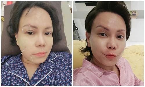 Việt Hương bị méo mặt, giờ thế nào?