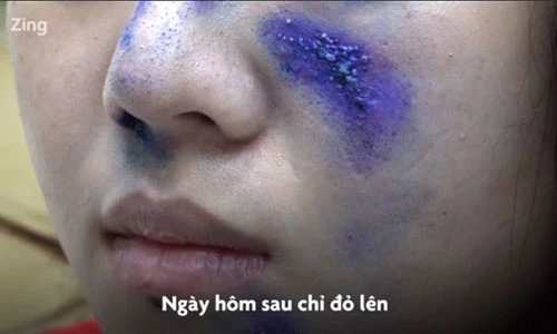 Video: Nỗi khổ vì kiến ba khoang tấn công của người dân TP.HCM