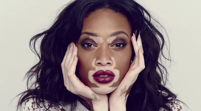 Hội chứng khiến người bệnh sở hữu vẻ ngoài kỳ dị “có 1 không 2“