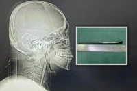 Chuyện hy hữu, 8 năm sống chung với chiếc đũa trong cổ họng