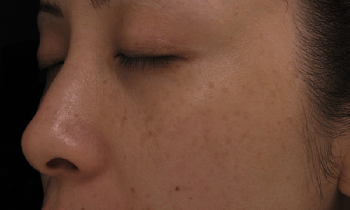 Nám là dấu hiệu lão hóa da khó nhận biết - Ảnh: Internet