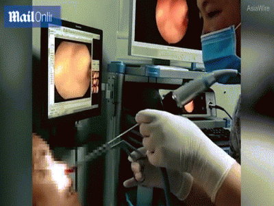 Bac sy loi 2 con dia ngoe nguay khoi mui nguoi dan ong