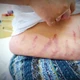 Từ con dị ứng mũi tự điều trị thành suy tuyến thượng thận