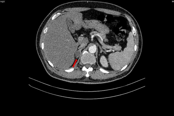 Tiểu khó đi khám người đàn ông phát hiện mắc đồng thời hai loại ung thư