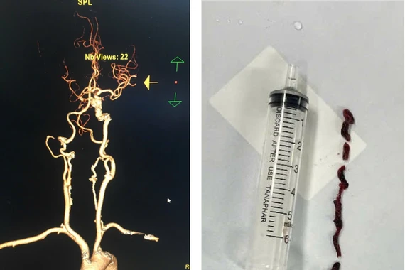 Phối hợp liên tuyến cứu cụ bà đột quỵ tại bệnh viện kịp thời 