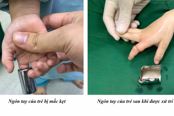 Cứu bé 4 tuổi kẹt tay trong ống sắt