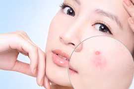 Giải pháp ngăn ngừa mụn hiệu quả