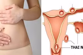 Vì sao chửa ngoài tử cung thường bị nhầm với sảy thai sớm?